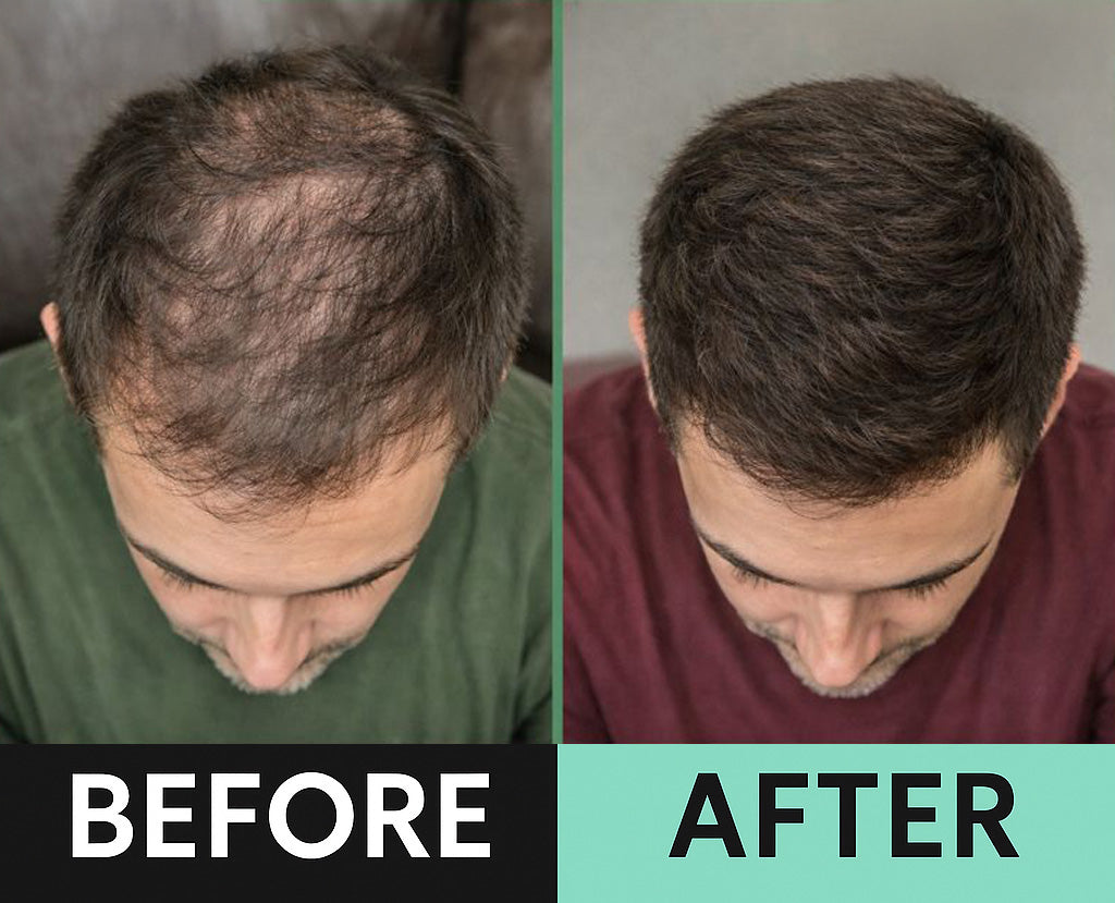 Bleve Micro Infusion System