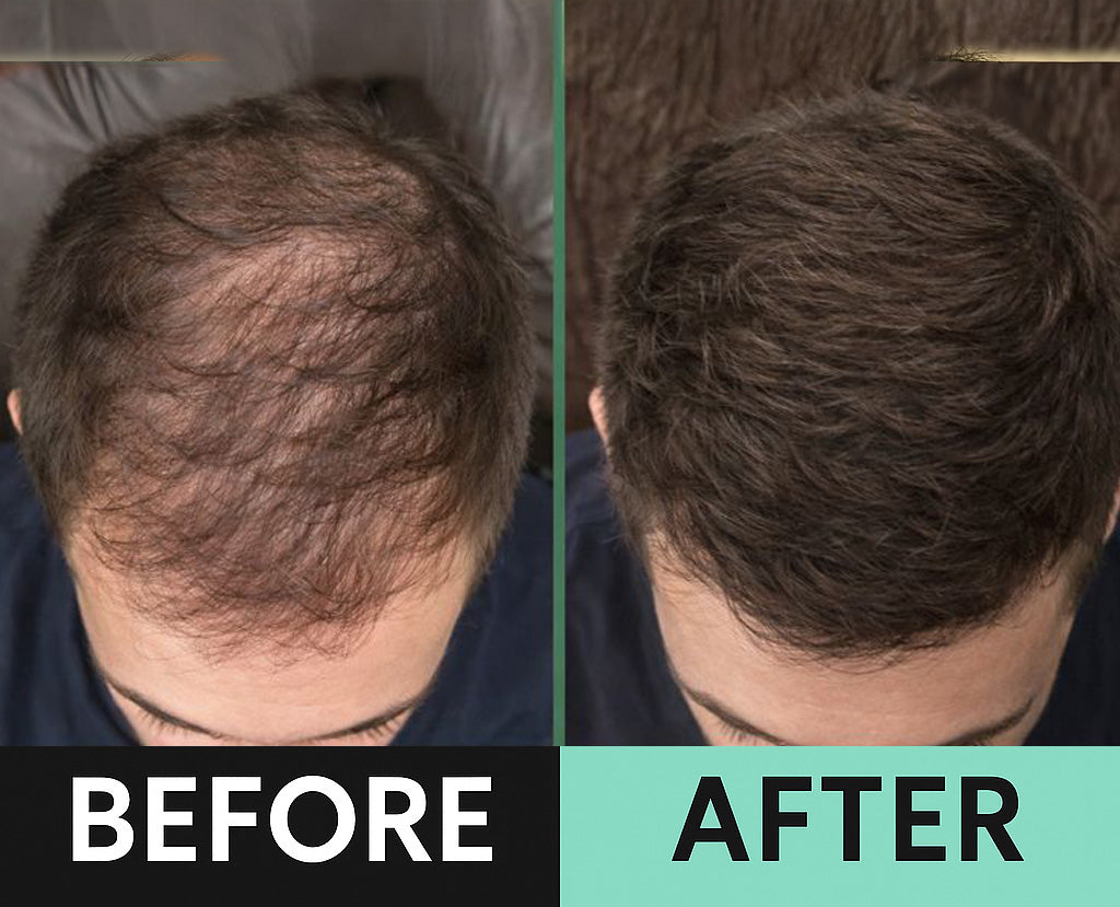 Bleve Micro Infusion System